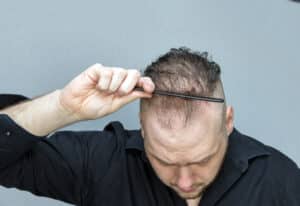 Man facing downward while combing through his hair to show how thin it's gotten, and how much scalp shows through