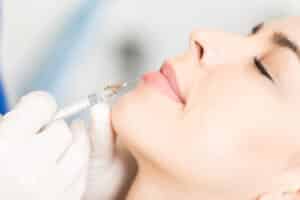 Side profile close-up of a smiling woman receiving lip filler dissolving injections for a more natural look.